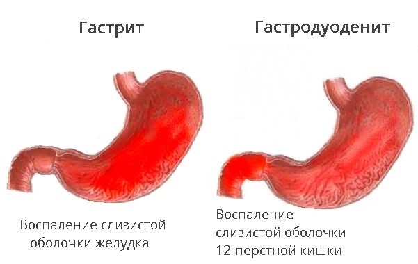 Хронический гастрит и армия